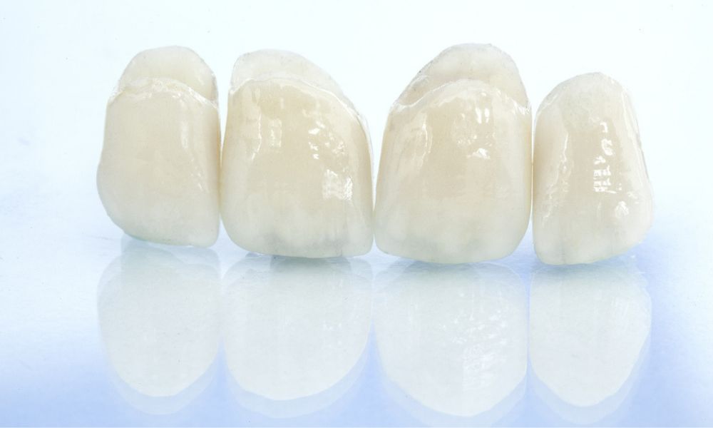 ceramic crowns