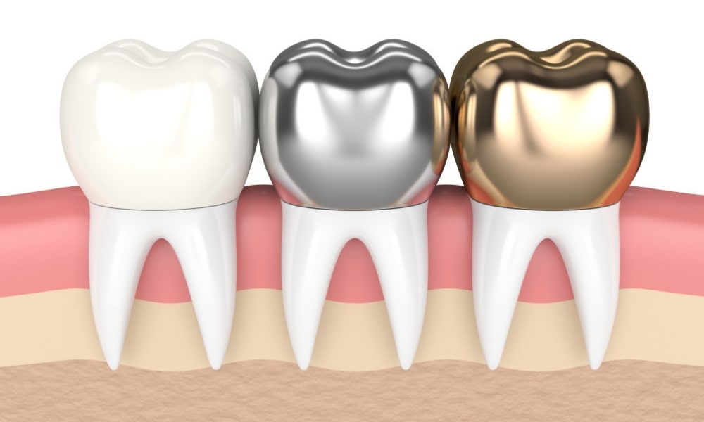 how long do dental crowns usually last