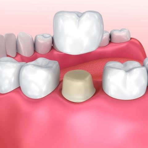 temporary tooth crown