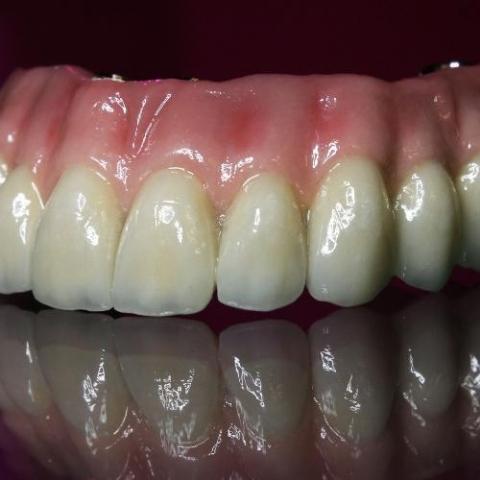 Zirconia Dental Crown