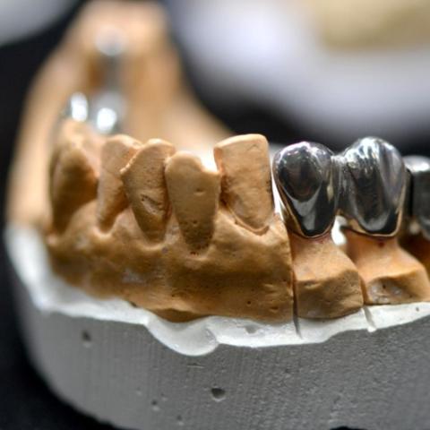 Pediatric stainless steel crowns